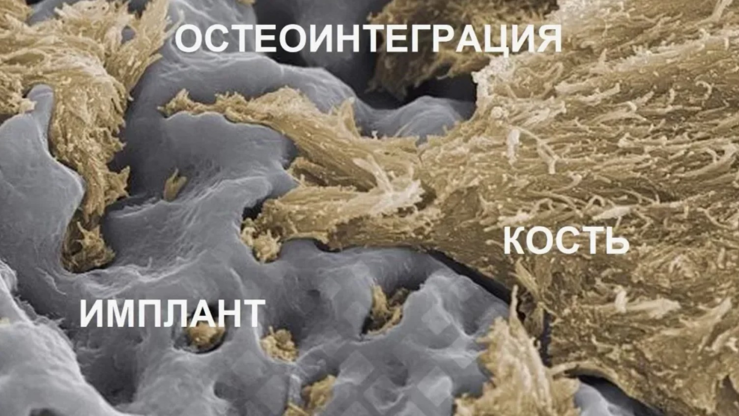 Остеоинтеграция протеза: кому подходит технология, какие у неё плюсы, риски и ограничения